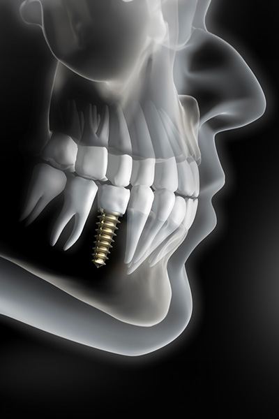 Dental Implant Procedure in Centreville, VA