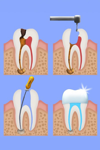 Root Canal Therapy in Centreville, VA