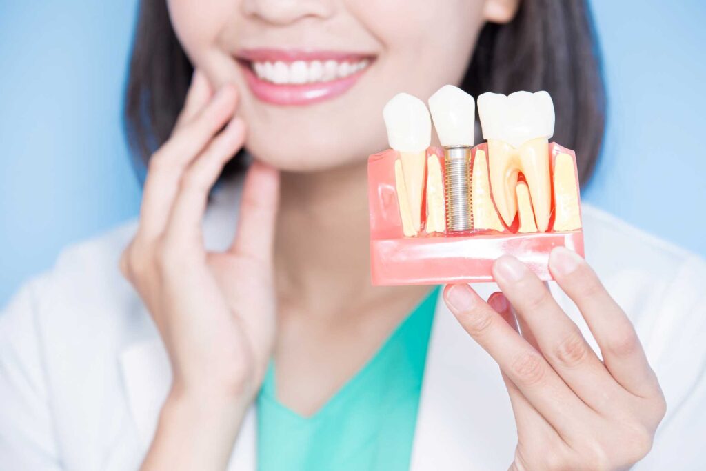 Dummy model of dental implants used in dental care treatments at Centreville, VA