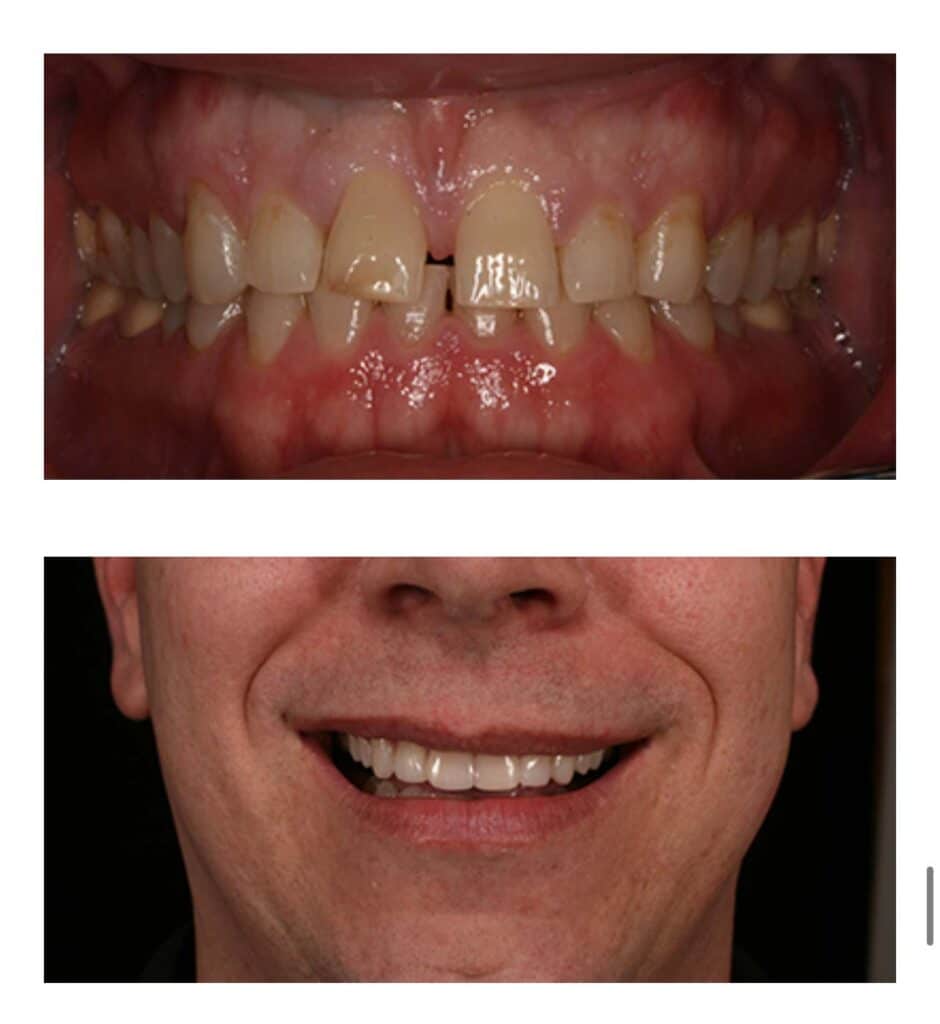 The before & after image of dental cleaning in Centreville, VA