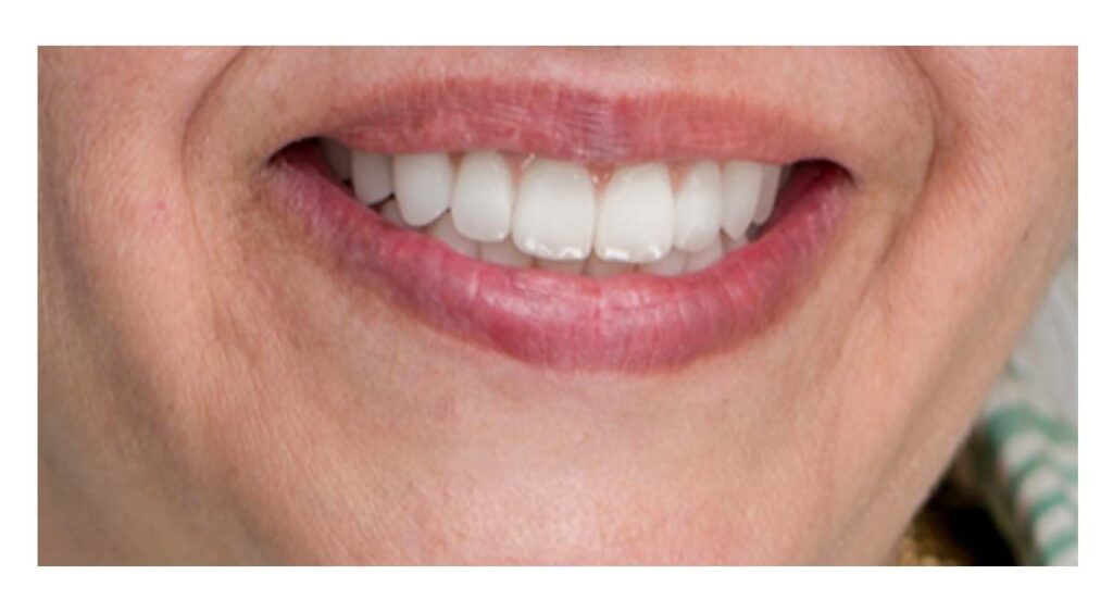 The before & after image of Gum surgery in Centreville, VA