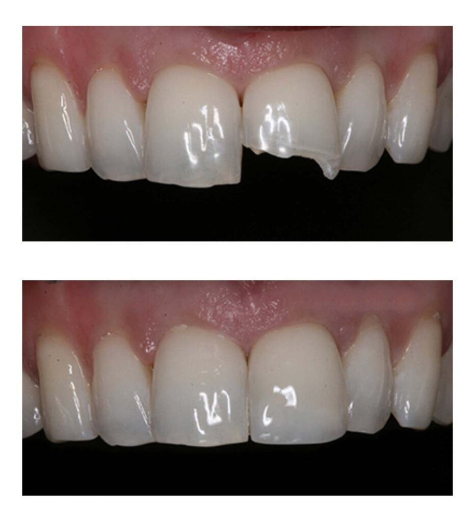 The before & after image of root canal treatment in Centreville, VA