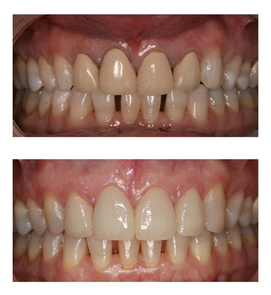 The before & after image of dental surgery in Centreville, VA