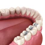 silver fillings