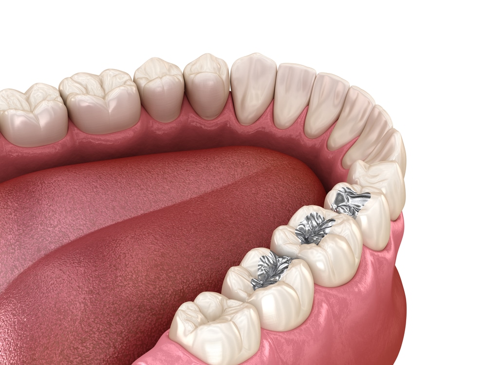 silver fillings