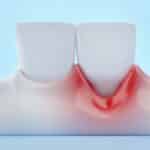 GingivalRecessionAndFrontTeethOnBlueBackground3dRendering