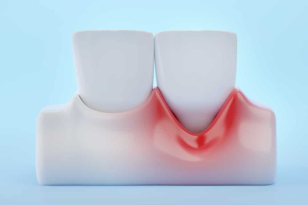 GingivalRecessionAndFrontTeethOnBlueBackground3dRendering