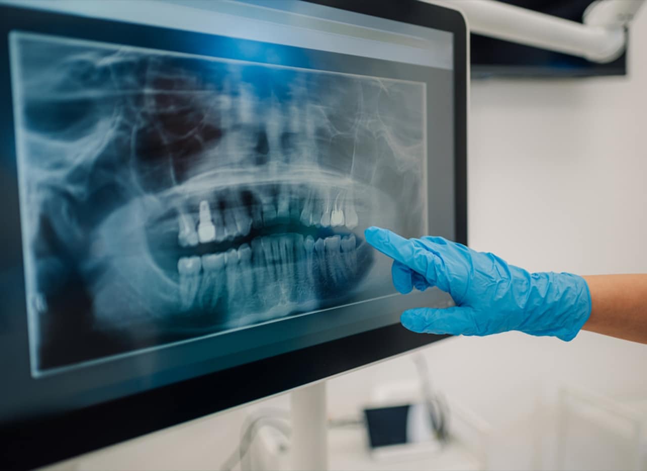 Digital-X-rays | Total Dental Arts Digital X-rays