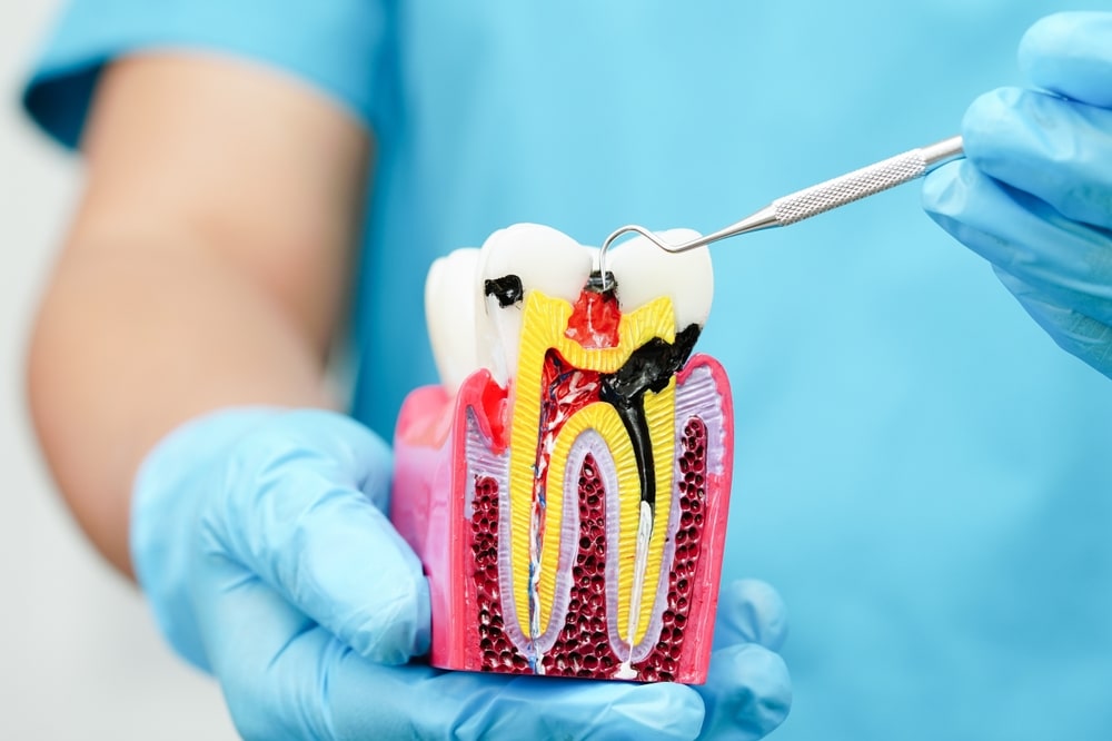 DentalImplantArtificialToothRootsIntoJawRootCanalOf | Total Dental Arts DentalImplantArtificialToothRootsIntoJawRootCanalOf