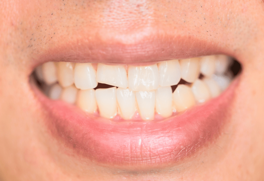 Smile with a chipped tooth.