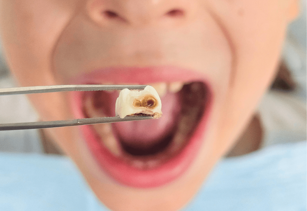 Tweezers holding tooth in front of boy's mouth.