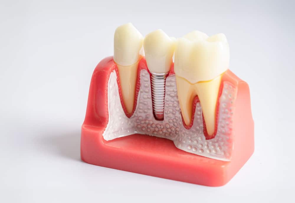 Model of a jaw section with dental implant between two teeth.