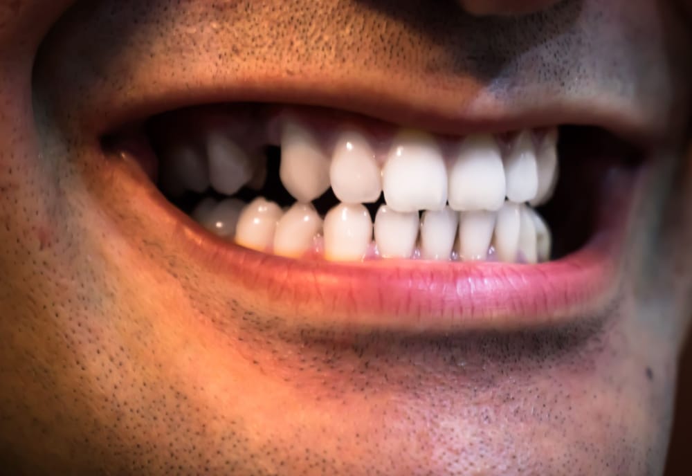 Close up of a man with a missing tooth needing dental restoration treatment.