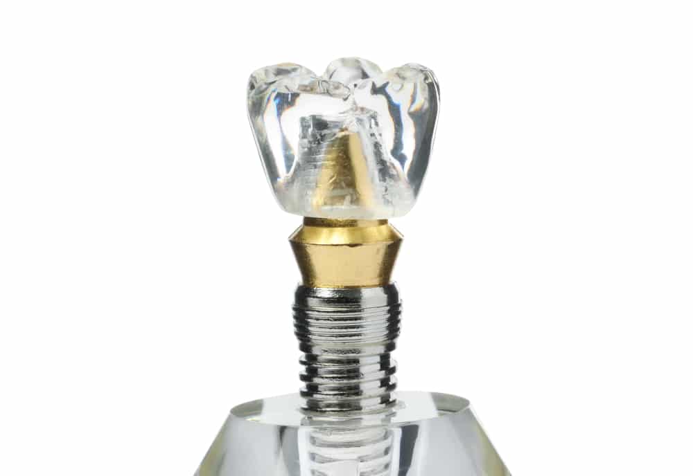 Model of a transparent crown on a gold abutment and silver implant screw.