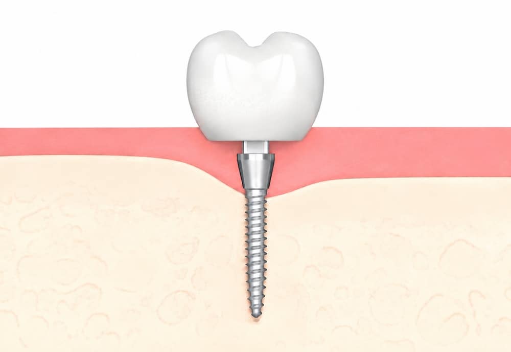 Illustration of a mini dental implant with crown in a jawbone.