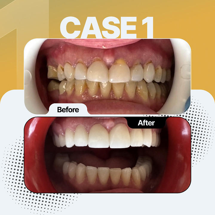 Before and after dental treatment - Case 1
