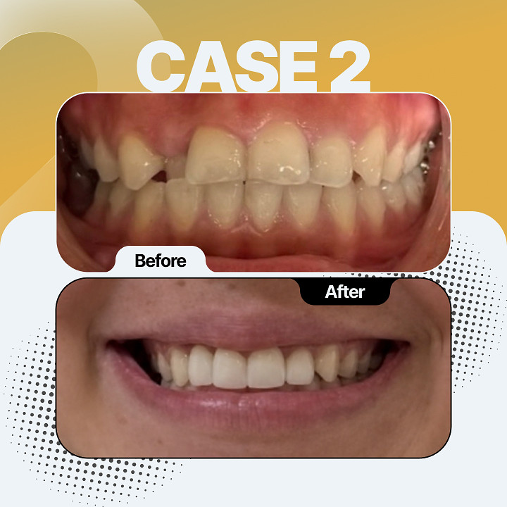 Before and after dental treatment - Case 2