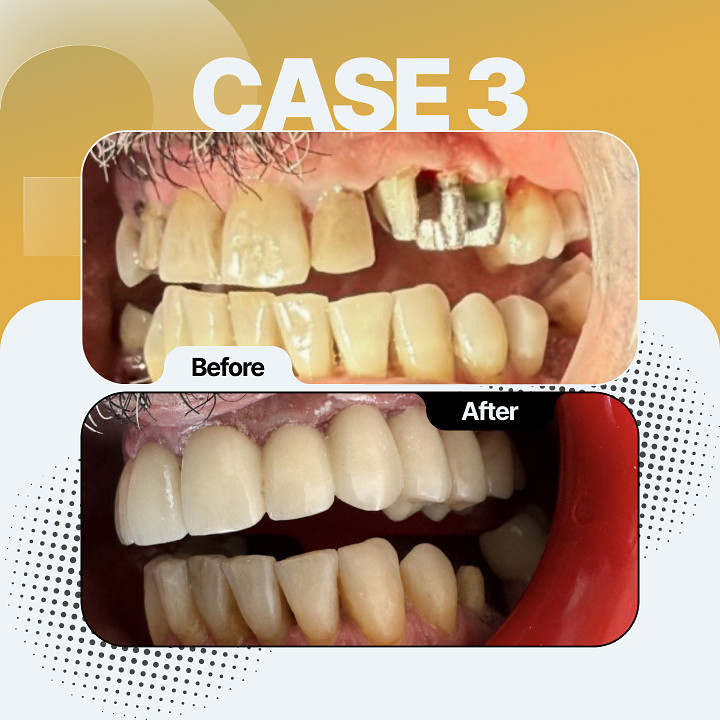 Before and after dental treatment - Case 3