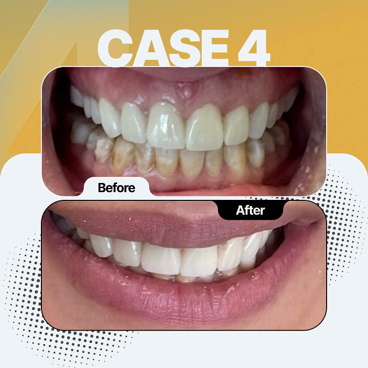 Before and after dental treatment - Case 4