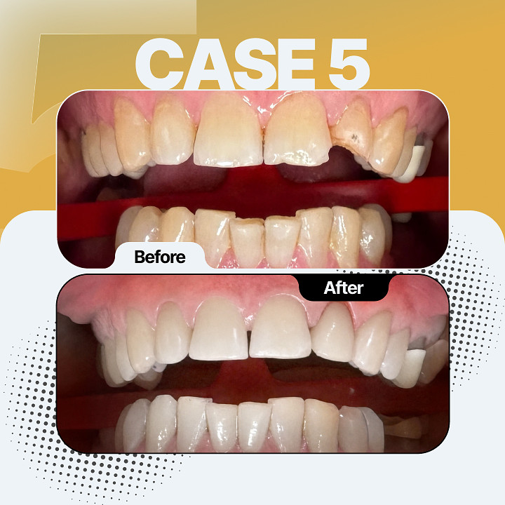 Before and after dental treatment - Case 5