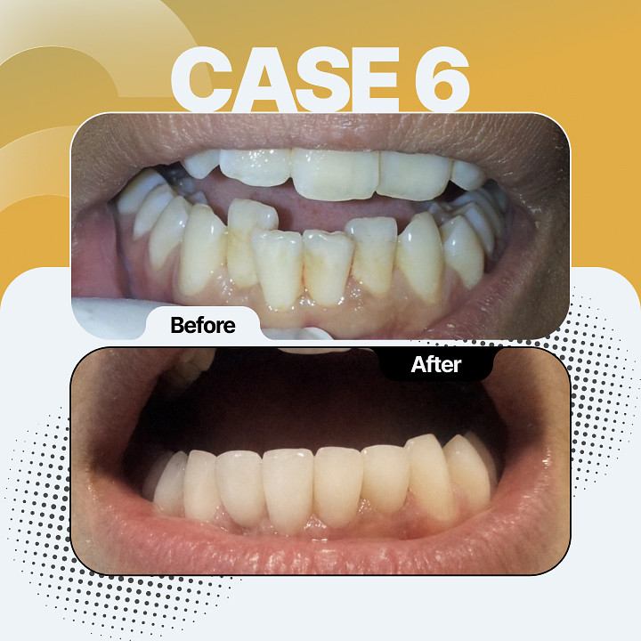 Before and after dental treatment - Case 6